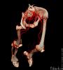 3D CT blodkrl ben